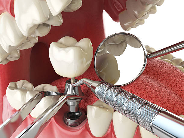 Best Broken or Chipped Tooth Repair in South Creek, WA
